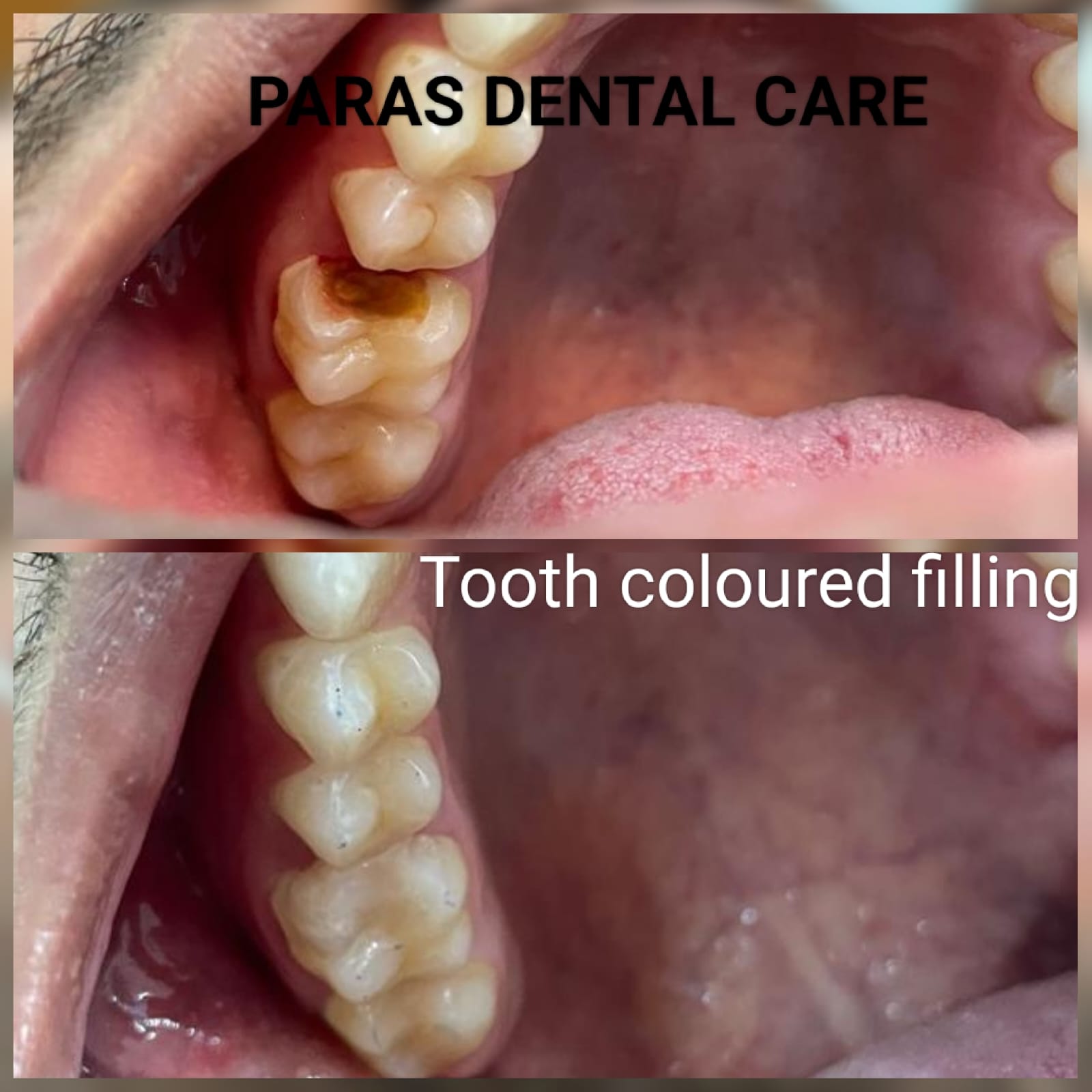 🦷 Restore Your Smile with Expert Dental Filling... main image