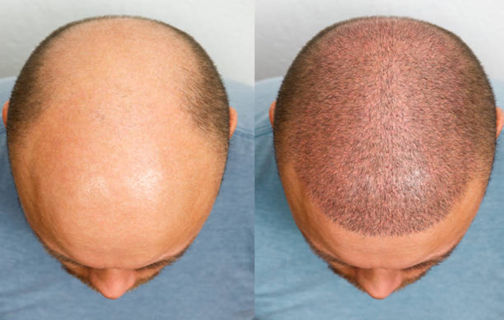 Things To Know About Hair Transplant Surgery
Ha... main image