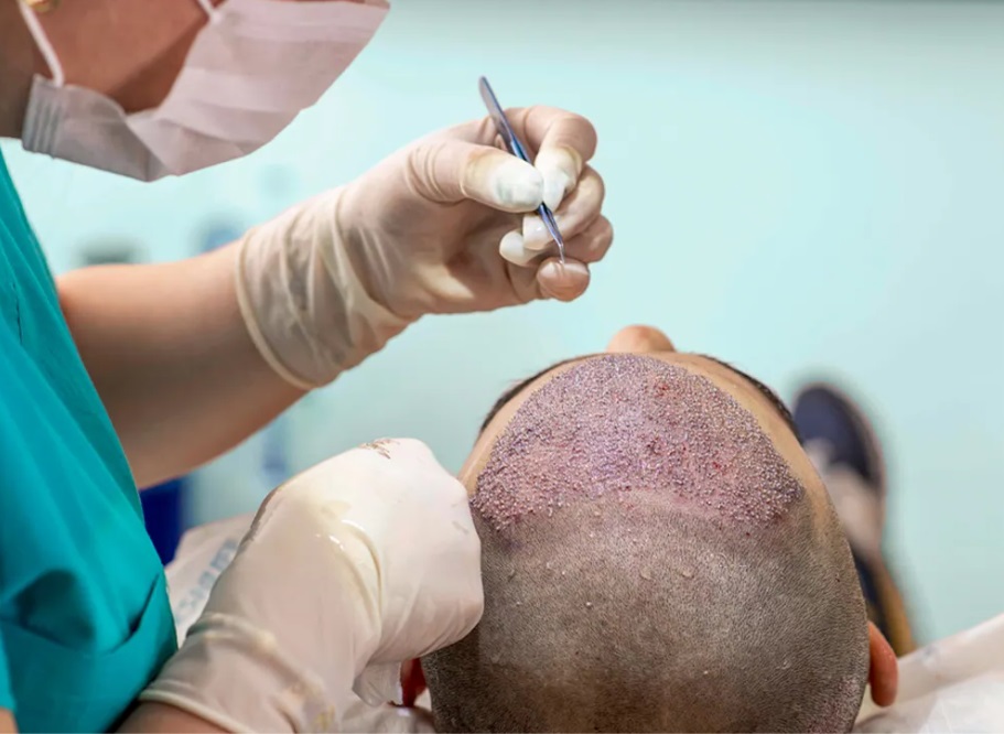 Advanced FUE Hair Transplant Surgery: Detailed ... main image