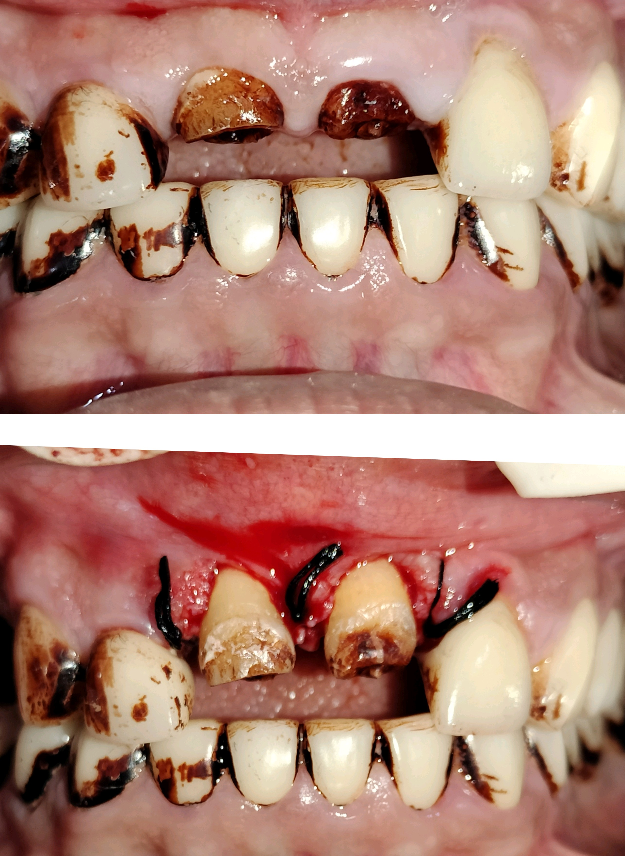 When you have tooth of very less height that you w... main image