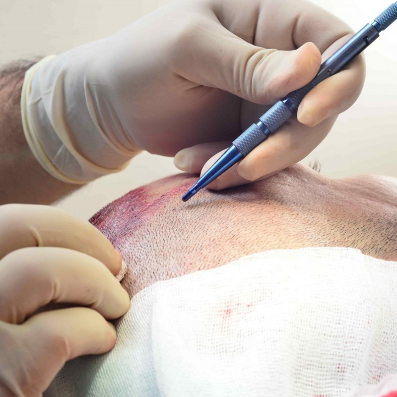 Key Success Factors for FUE Hair Transplantatio... main image