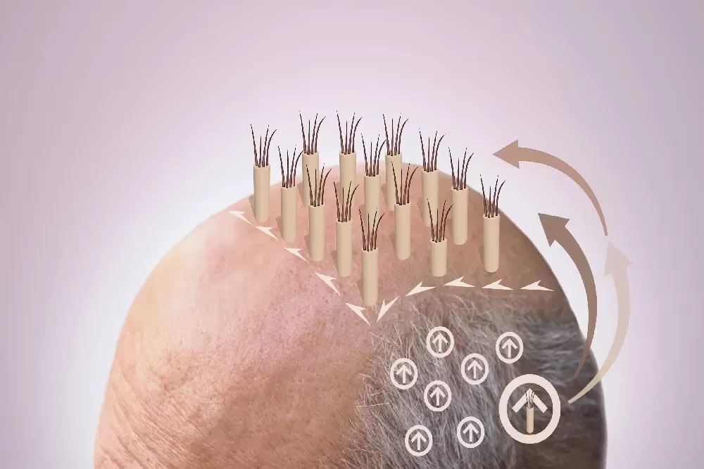 Things to Know Before Undergoing a Hair Transpl... main image