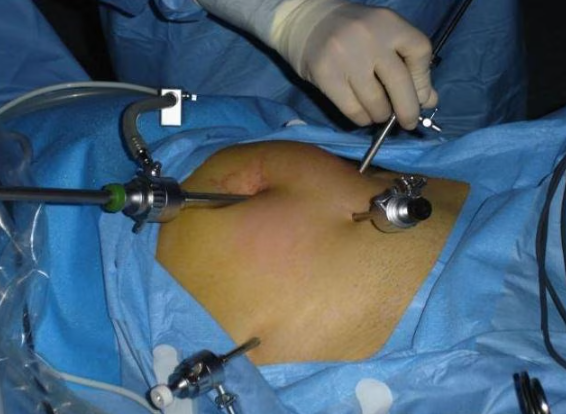 Advanced Gynaecological Laparoscopic Surgeries ... main image