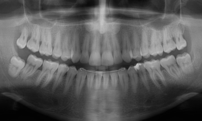 OPG (Dental Imaging)