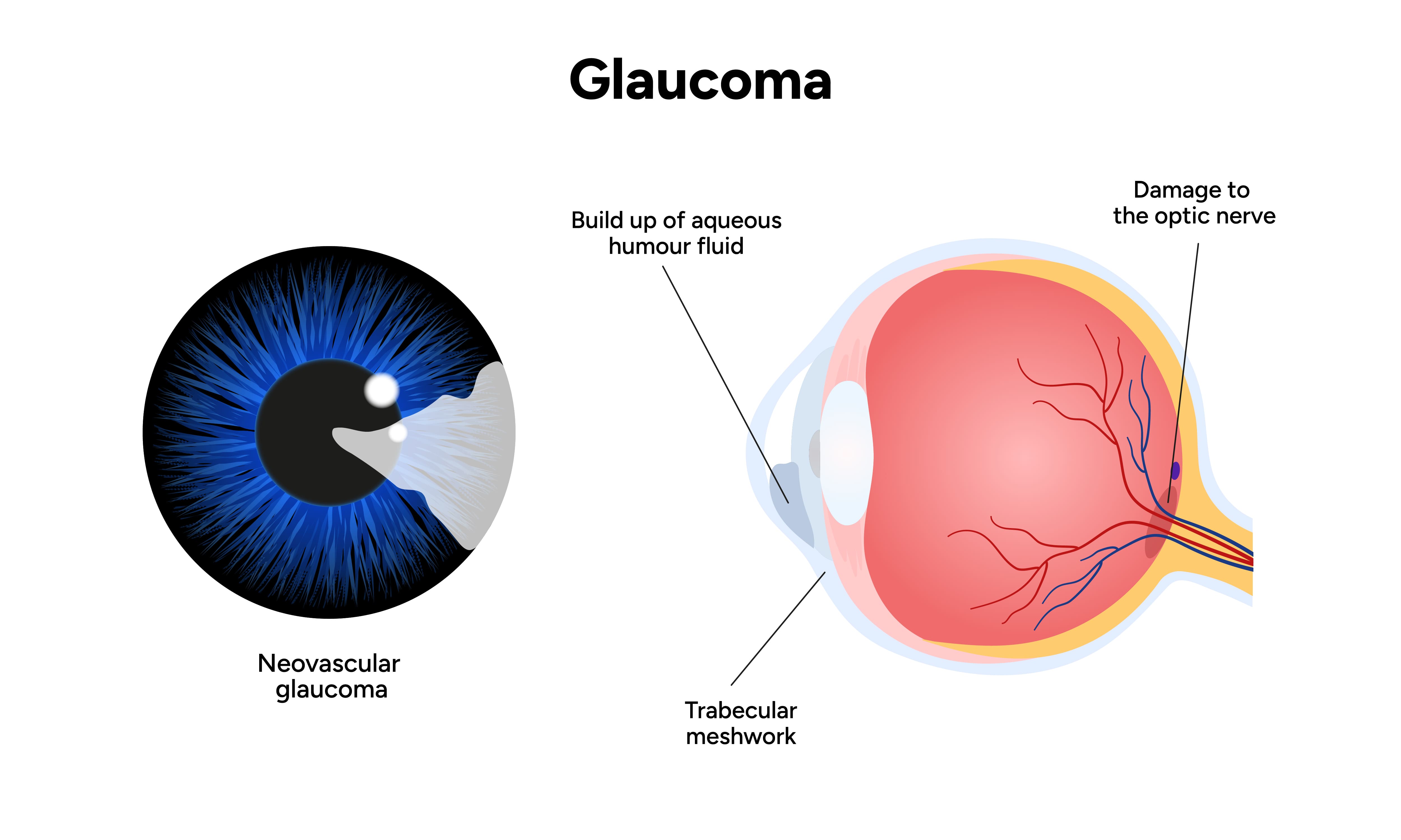 Optic nerve glaucoma advanced blindness