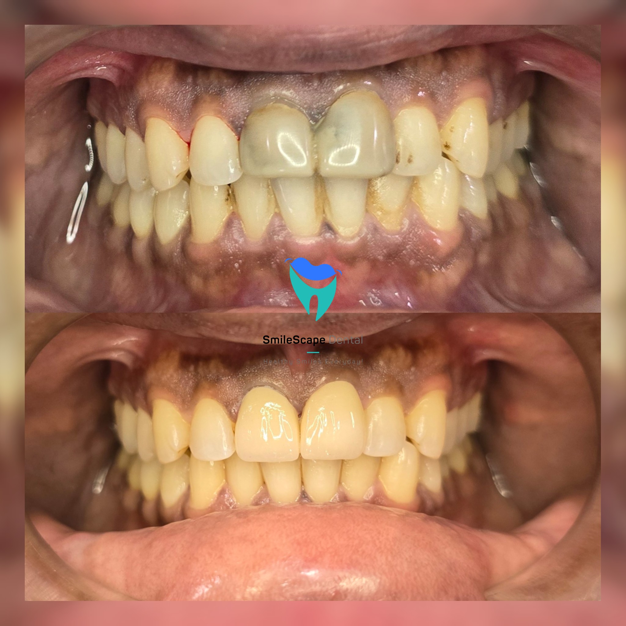 Decayed or discolored front teeth can pose sign... main image
