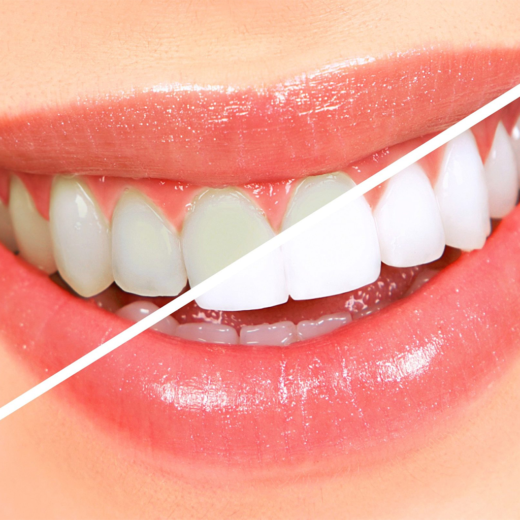 ✨ Brighten Your Smile with Professional Teeth Whit... main image