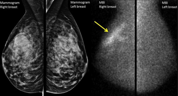 Mammography for Wome
