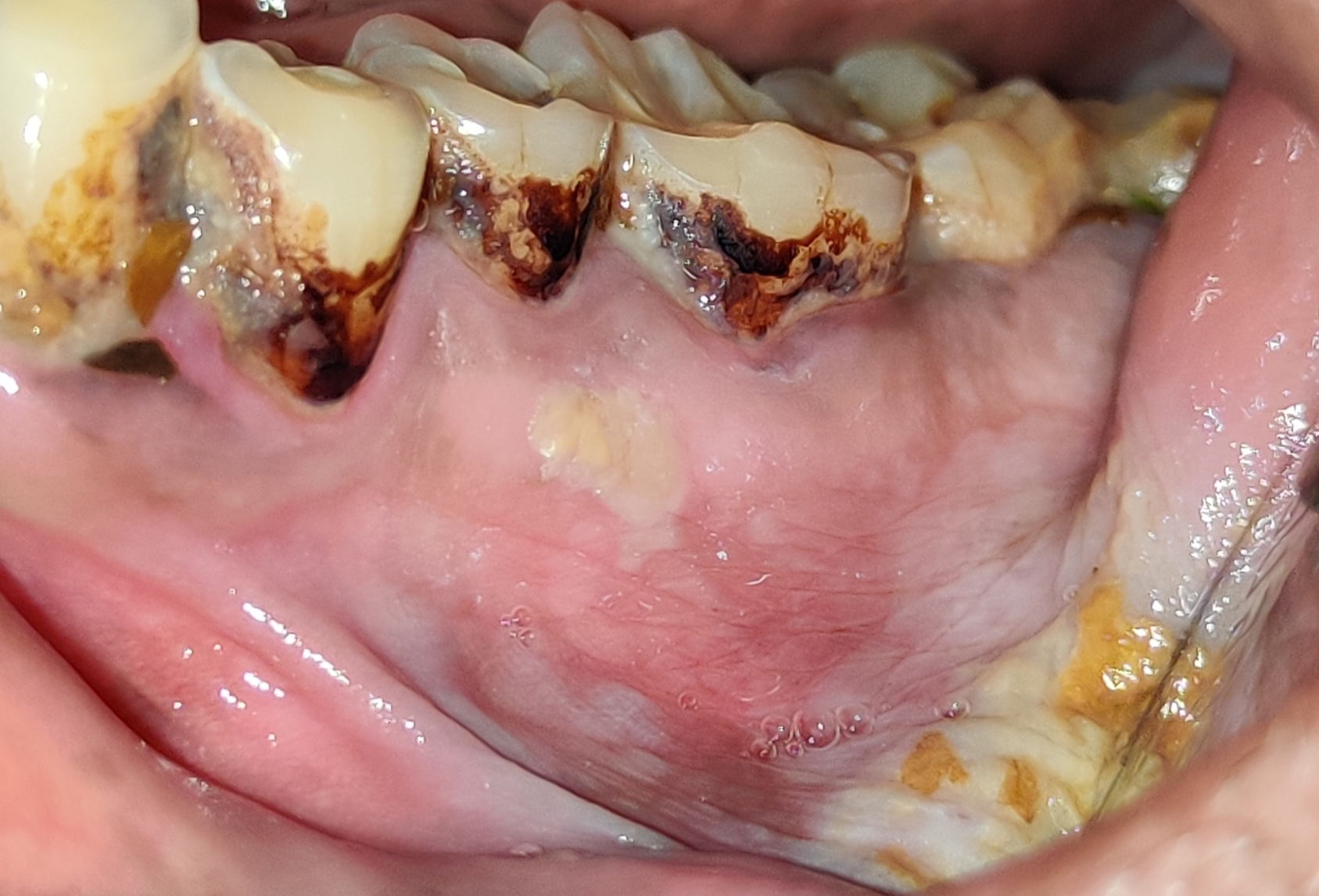 Pre-cancer and Cancer of oral cavity
India is ... main image