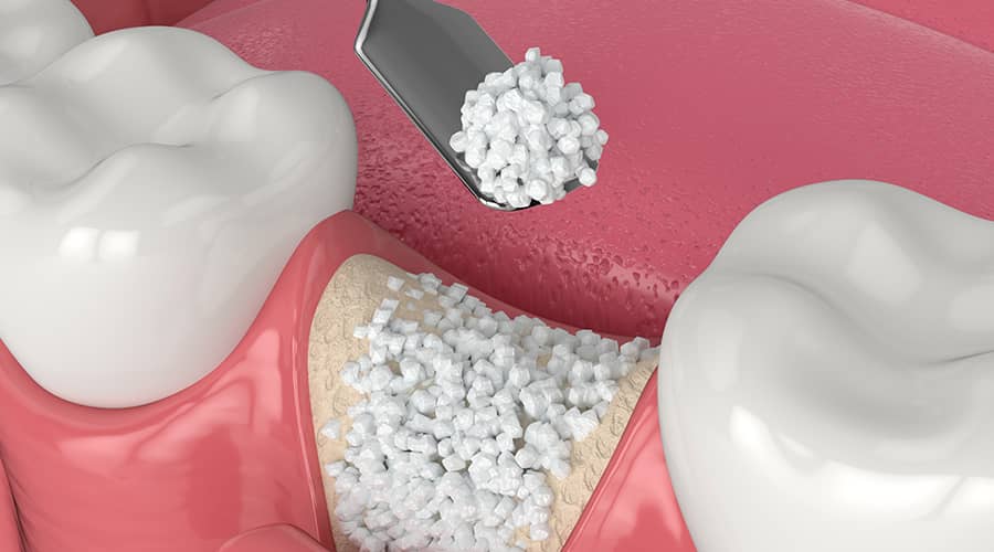 Paras Dental Care , Bone grafting is essential ... main image