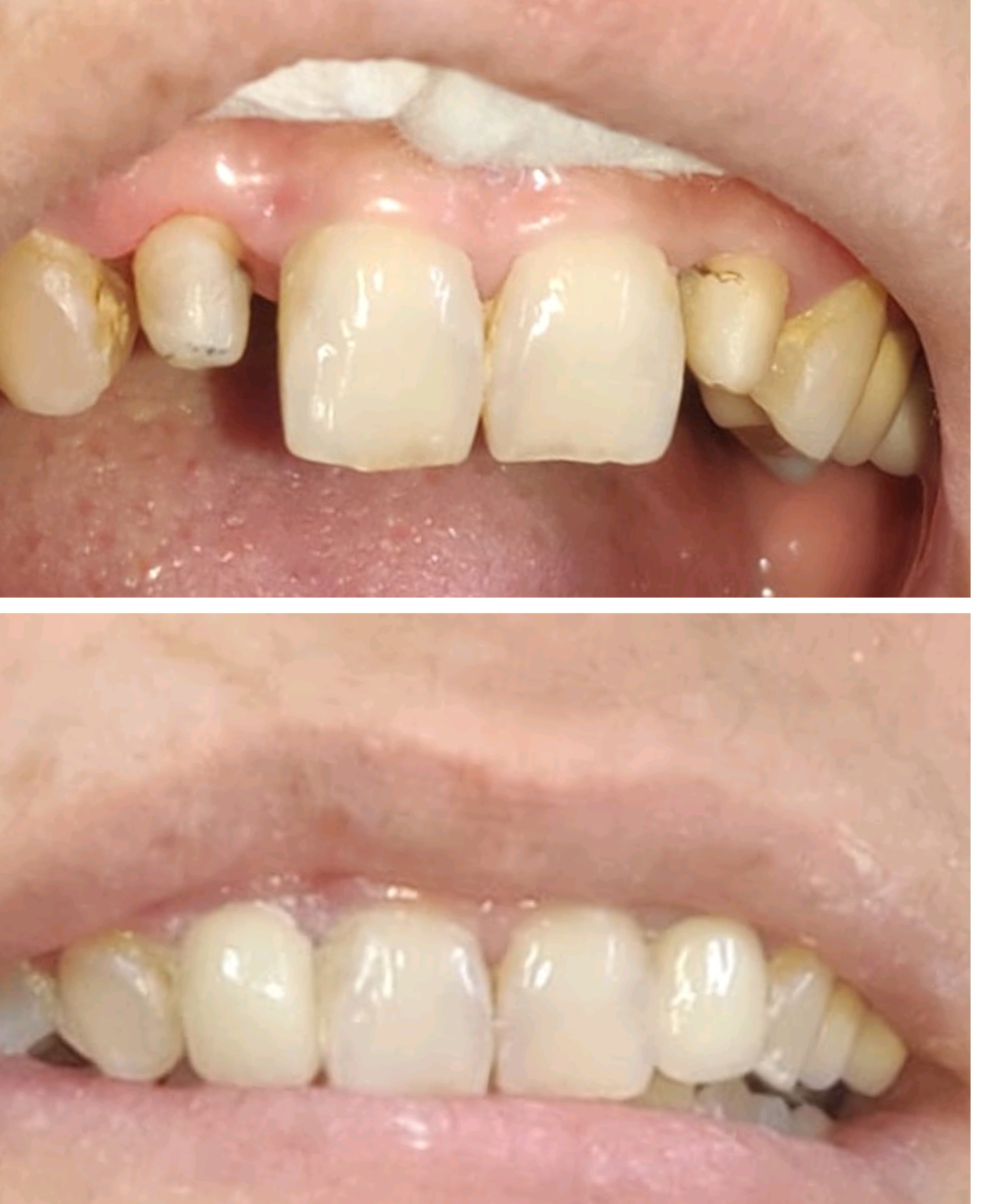 zirconia cap to fix your smile main image