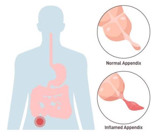 Appendix Surgeon in Mumbai When appendicitis st... main image