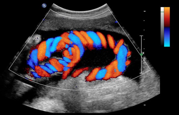Color Doppler Imagin