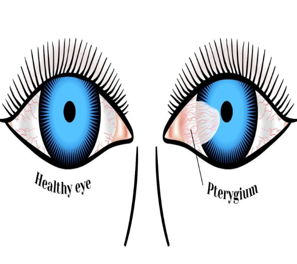 Pterygium: What You Need to Know Pterygium, a g... main image