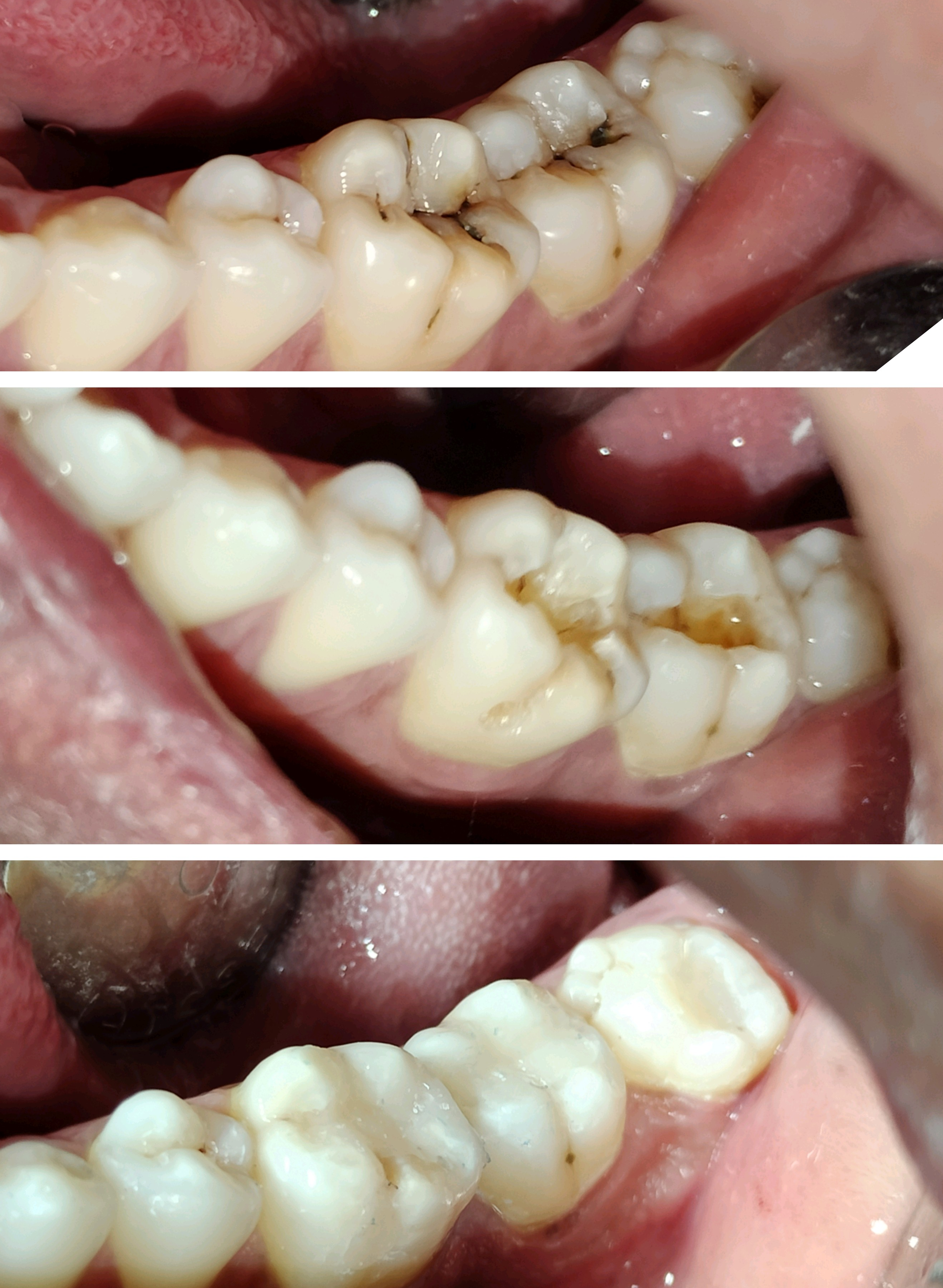 filling of teeth with composite cement to remov... main image