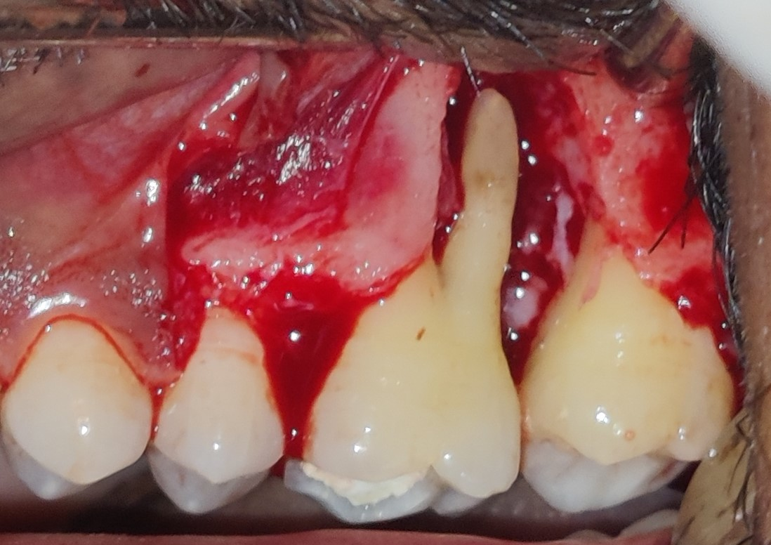 Saving Natural Teeth
Whatever the condition of a t... main image