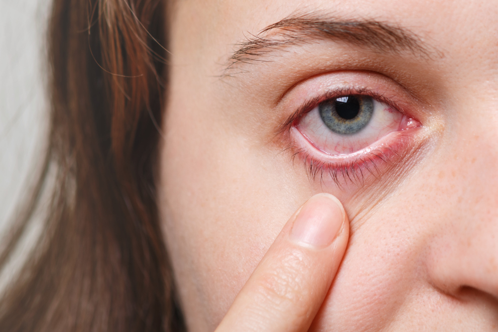 Dacryocystitis: Effective Treatments at Your Fi... main image