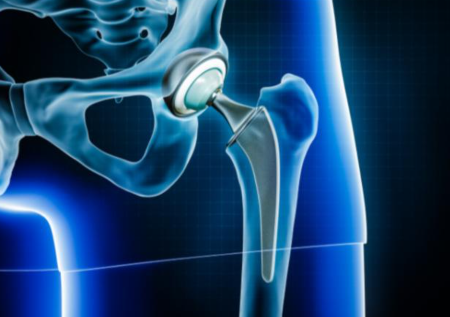 Best Hip Replacement Services in Chennai For those... main image