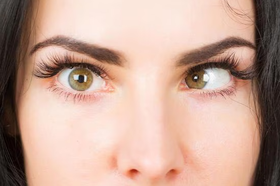 Squint: Understanding and Treatment Options Squ... main image