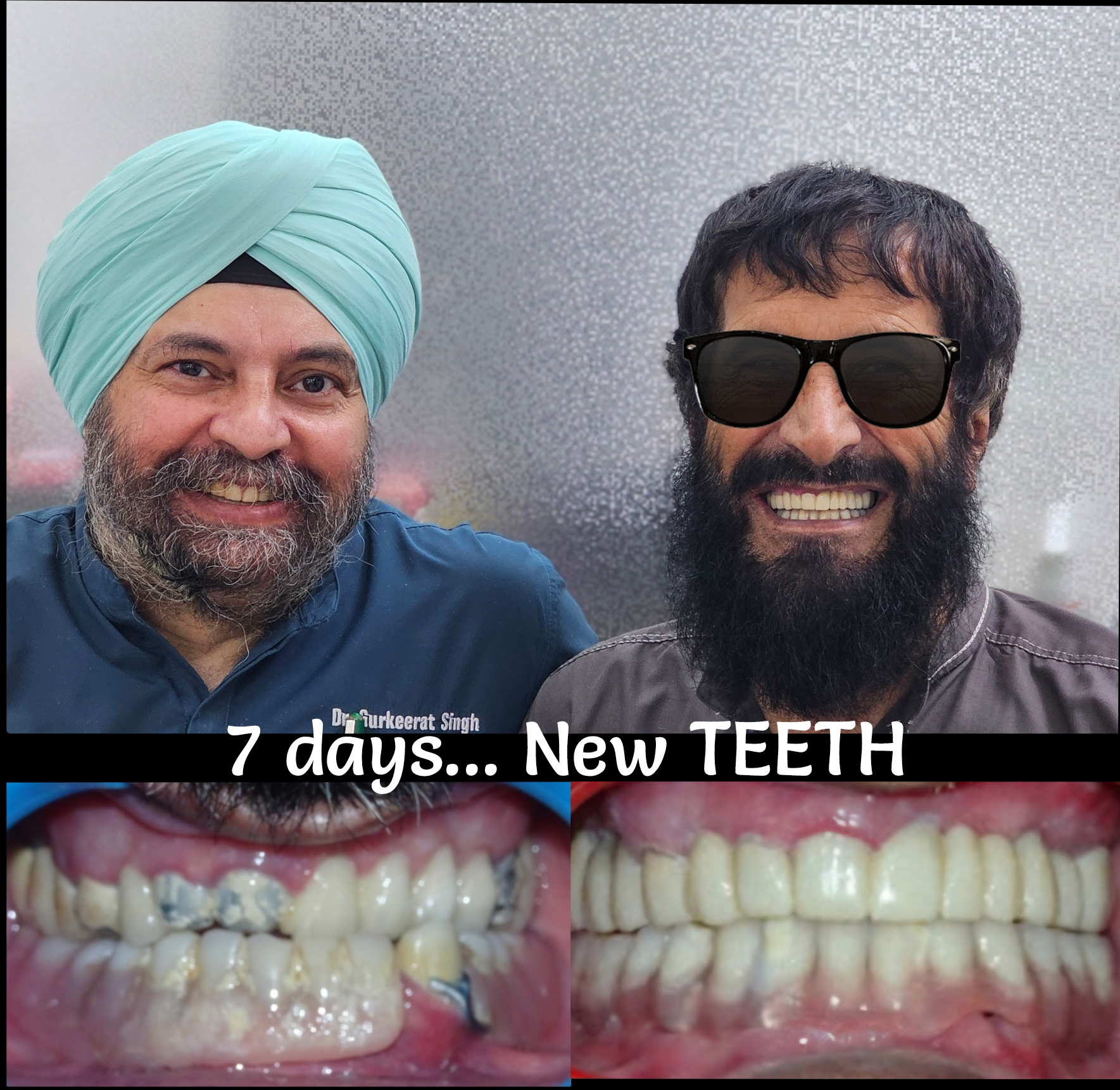 Implant assisted upper and lower jaw rehabilita... main image