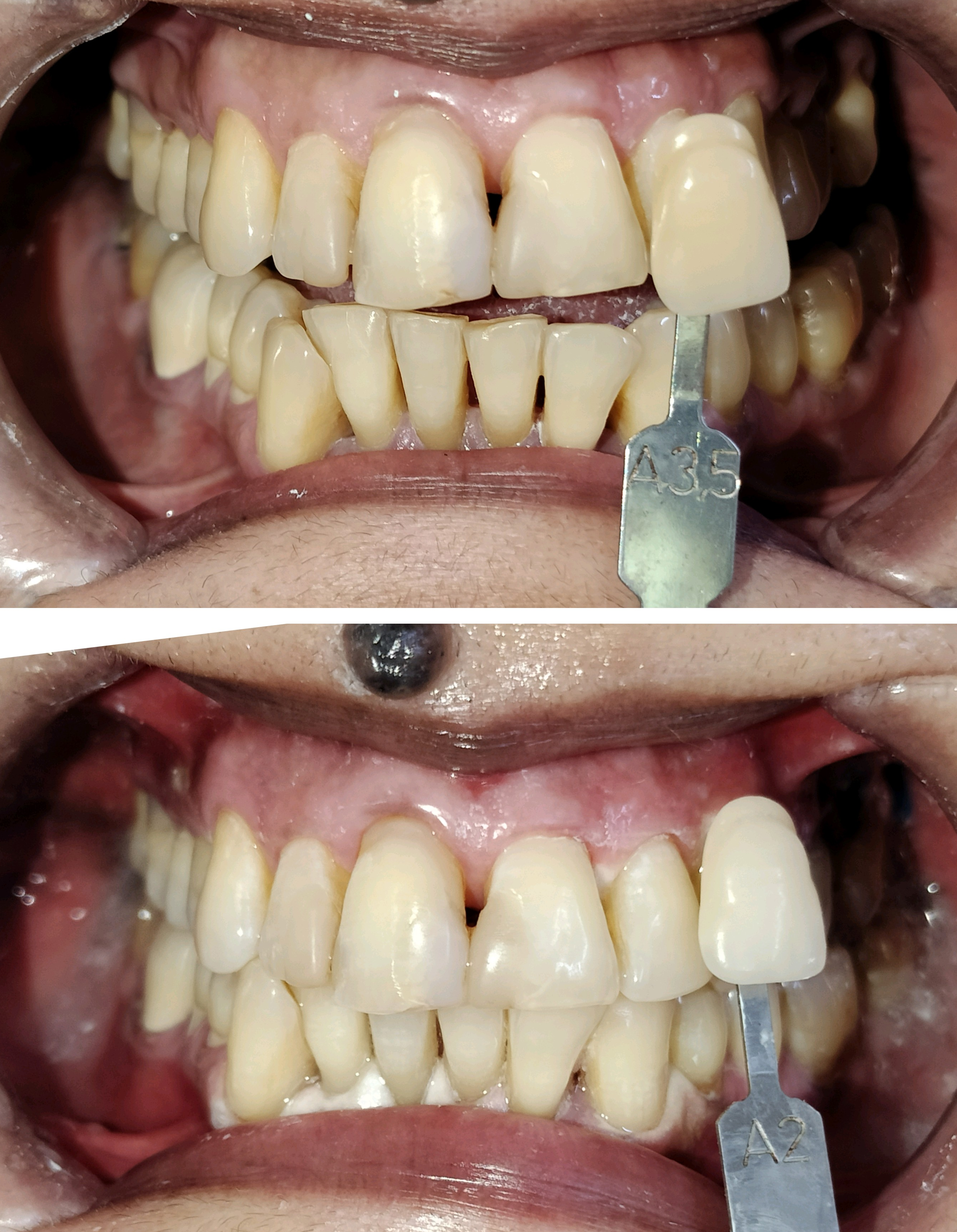Teeth whitening procedure done at Dent-O-Facial... main image