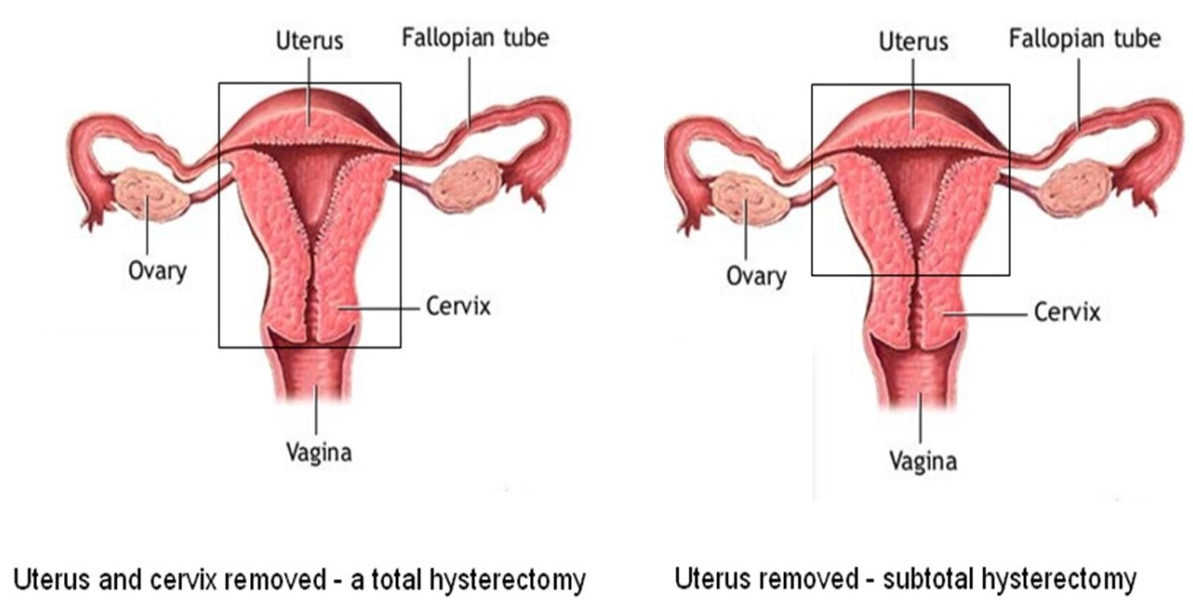 Hysterectomy: Compassionate Surgical Care Facin... main image