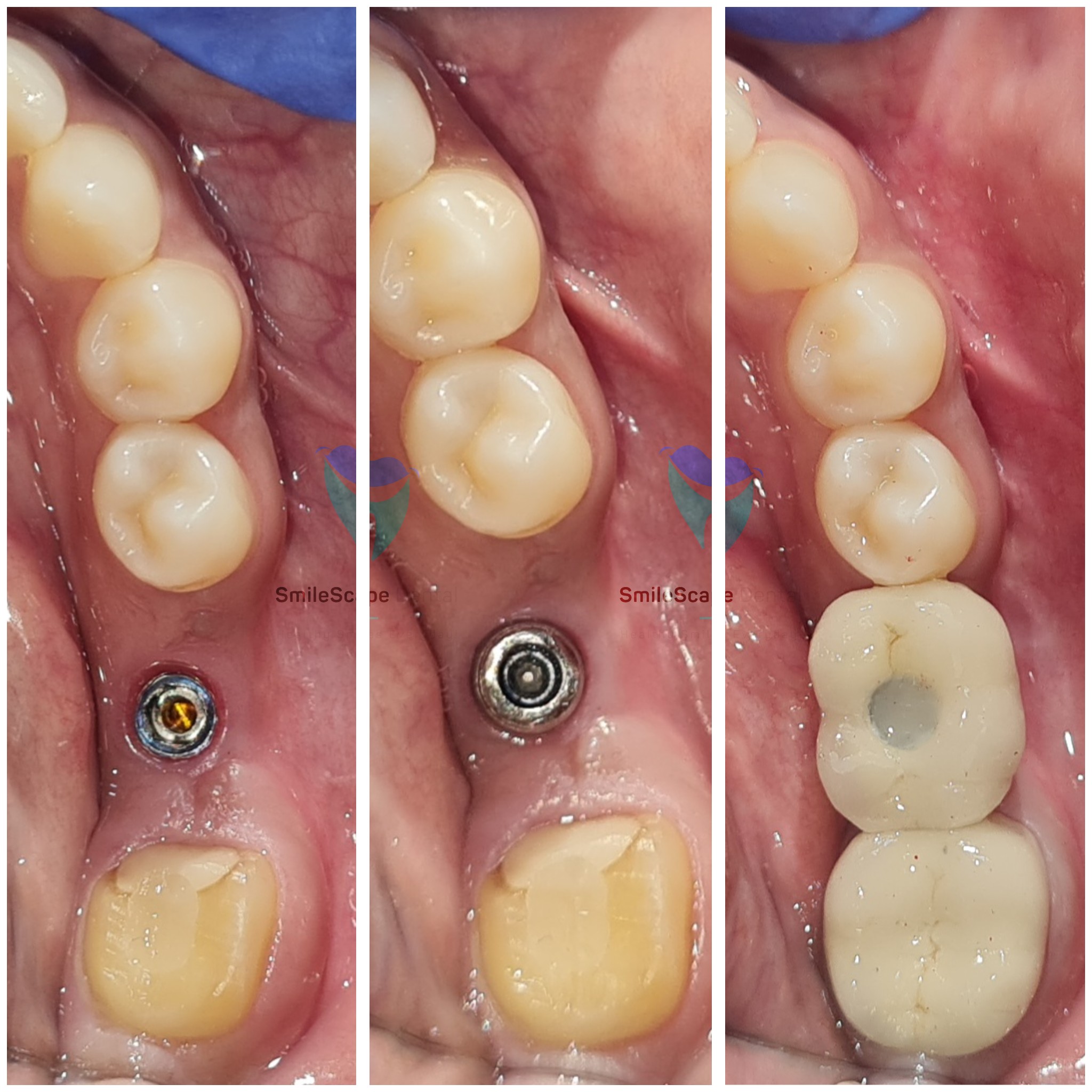 Missing teeth can pose problems with esthetics ... main image