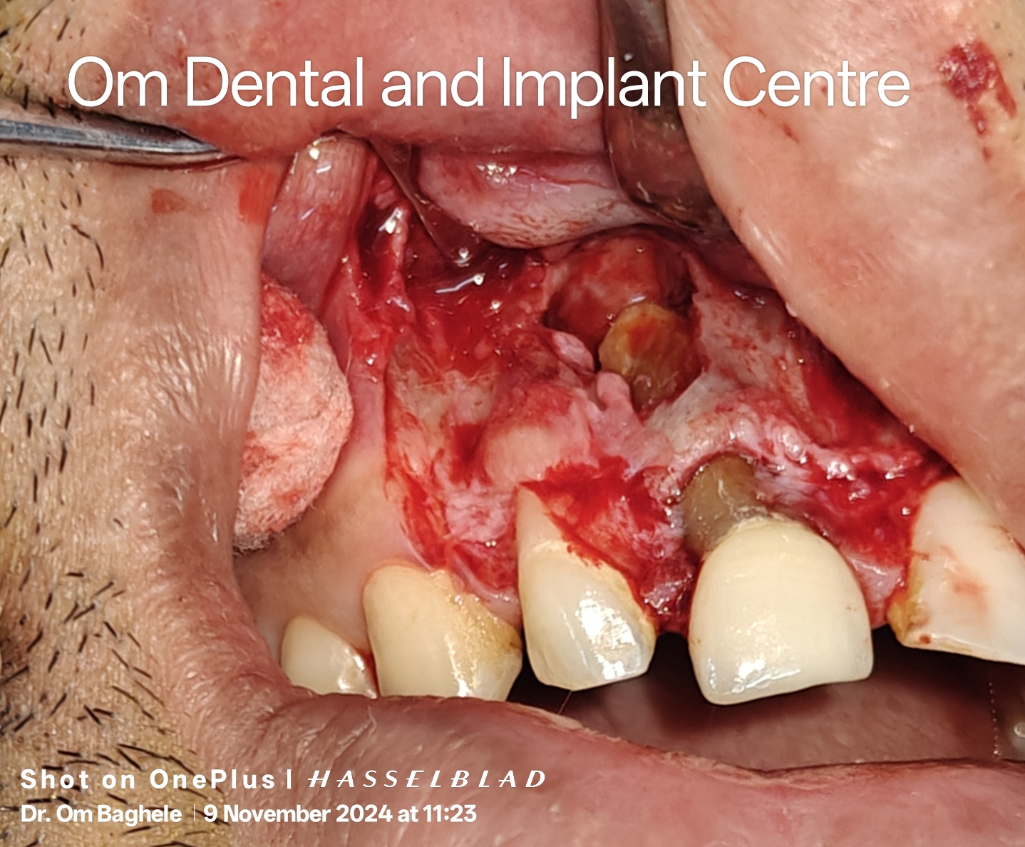 Periapical Surgery 
In few cases, even after do... main image