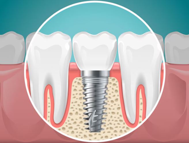 Implants Services in Nagpur For those seeking perm... main image