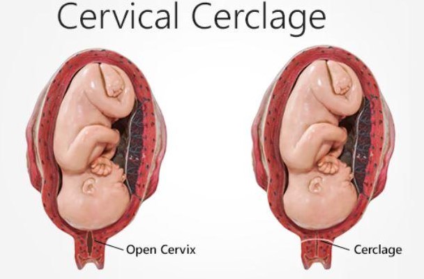 Cervical Cerclage in Nagpur: Supporting High-Ri... main image