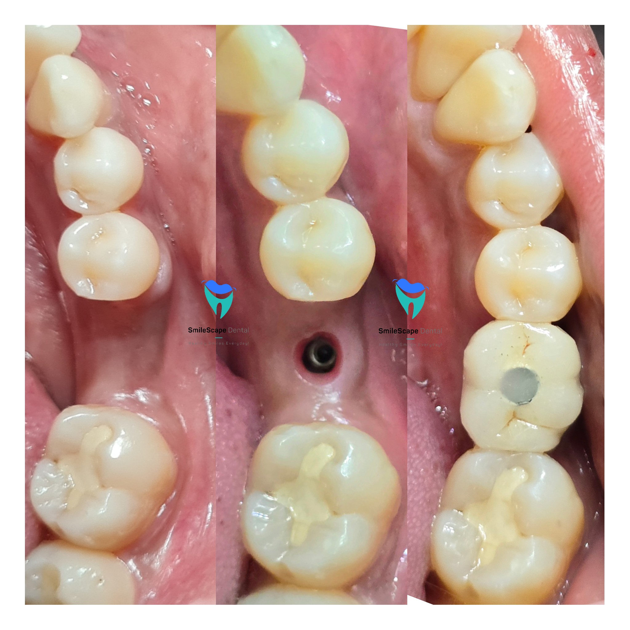 Each and every tooth in the mouth plays an impo... main image