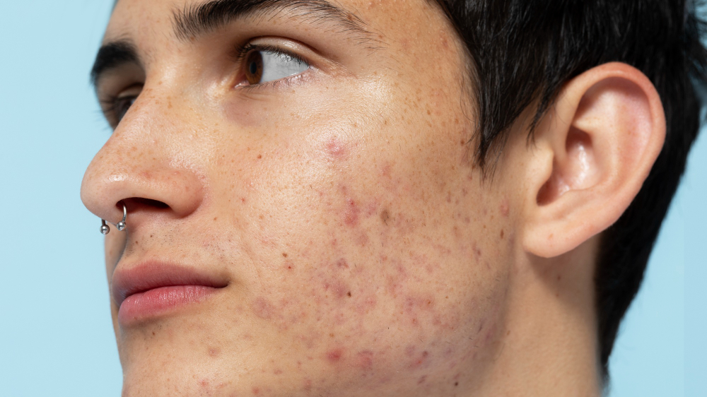 Acne and Acne Scars Treatment Near Nungambakkam De... main image