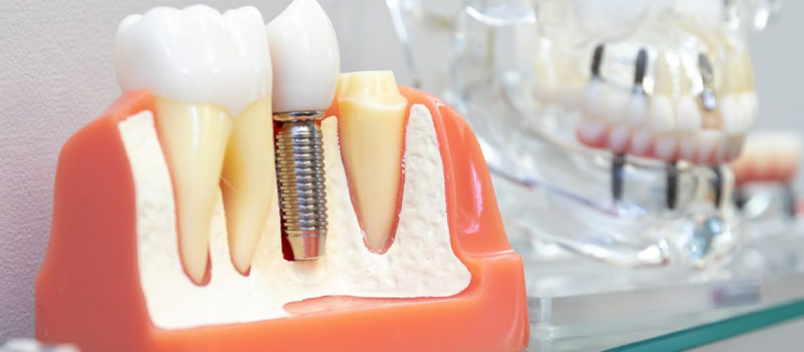 # Dental implant cost in Kalwa Thane
* Dental ... main image