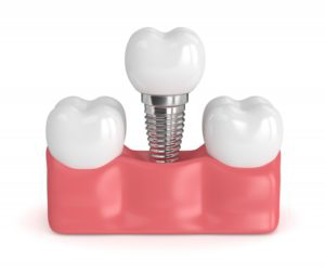 # Dental implants in Kharegaon Kalwa
* Dental ... main image