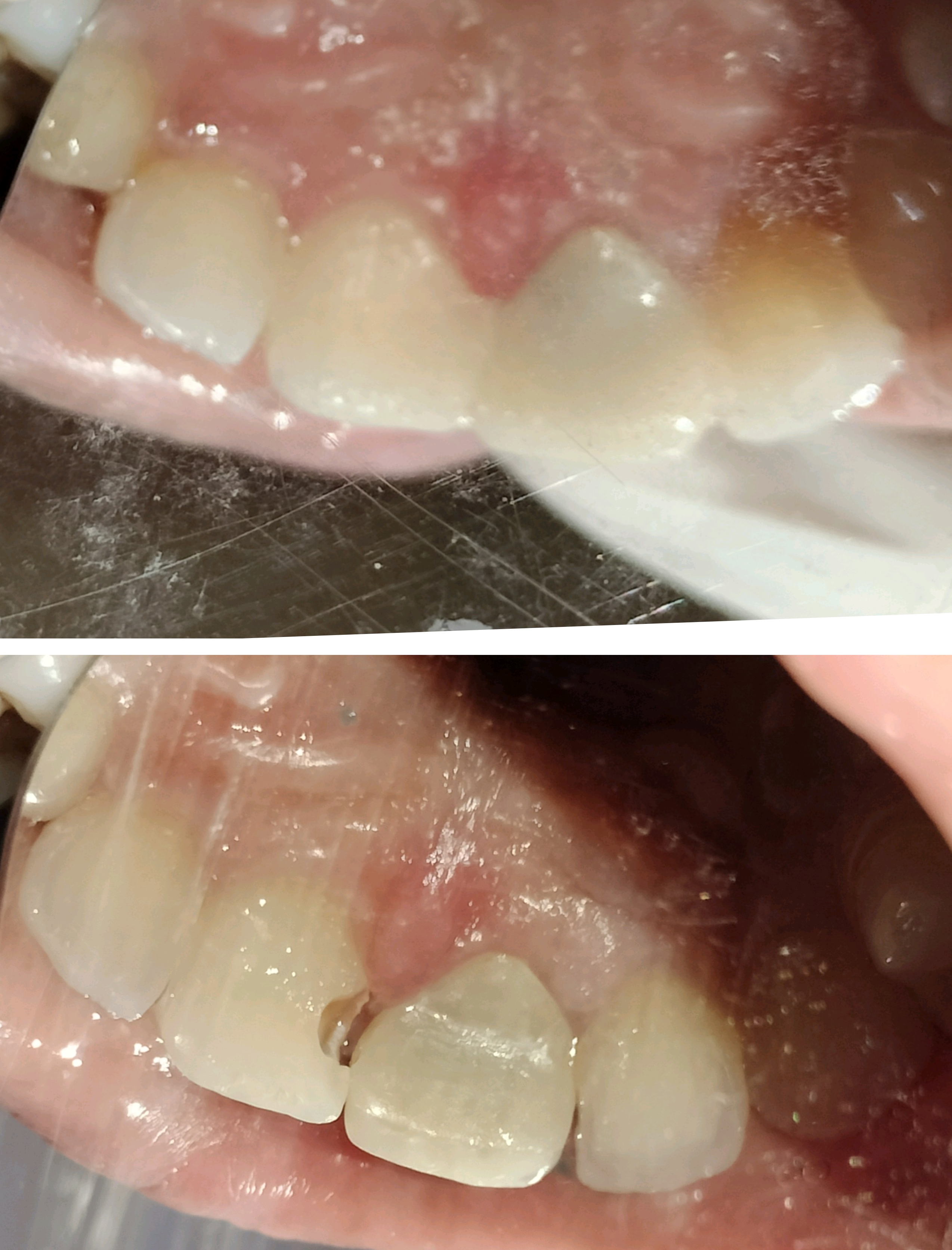 Decay removal and filling done @dent-o-facial d... main image