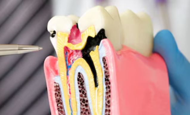 Root Canal Treatment in Nagpur If you're experienc... main image