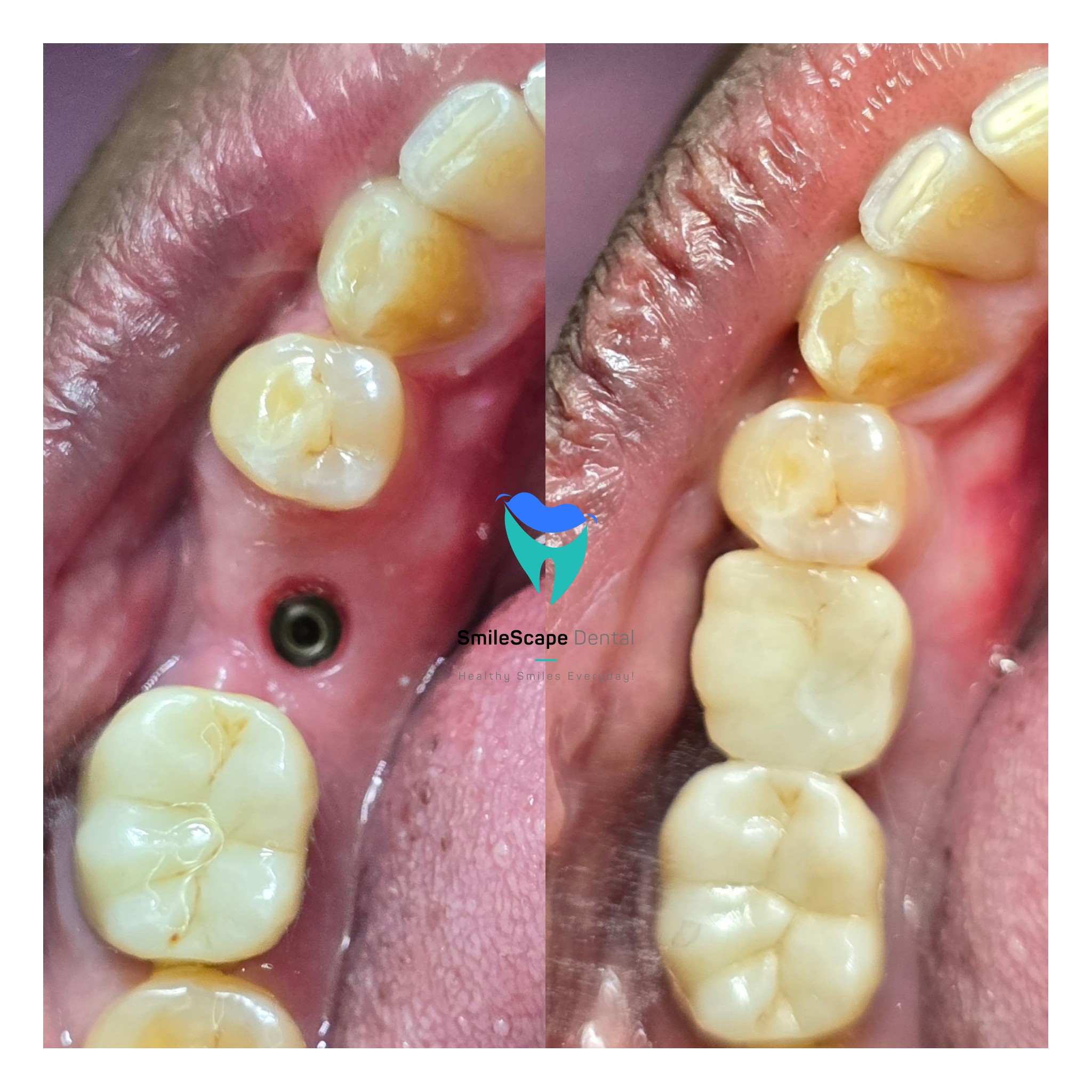 Missing back teeth can cause serious long term ... main image