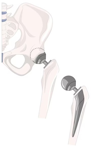Joint Replacement Hospital in Pune: Rediscover ... main image