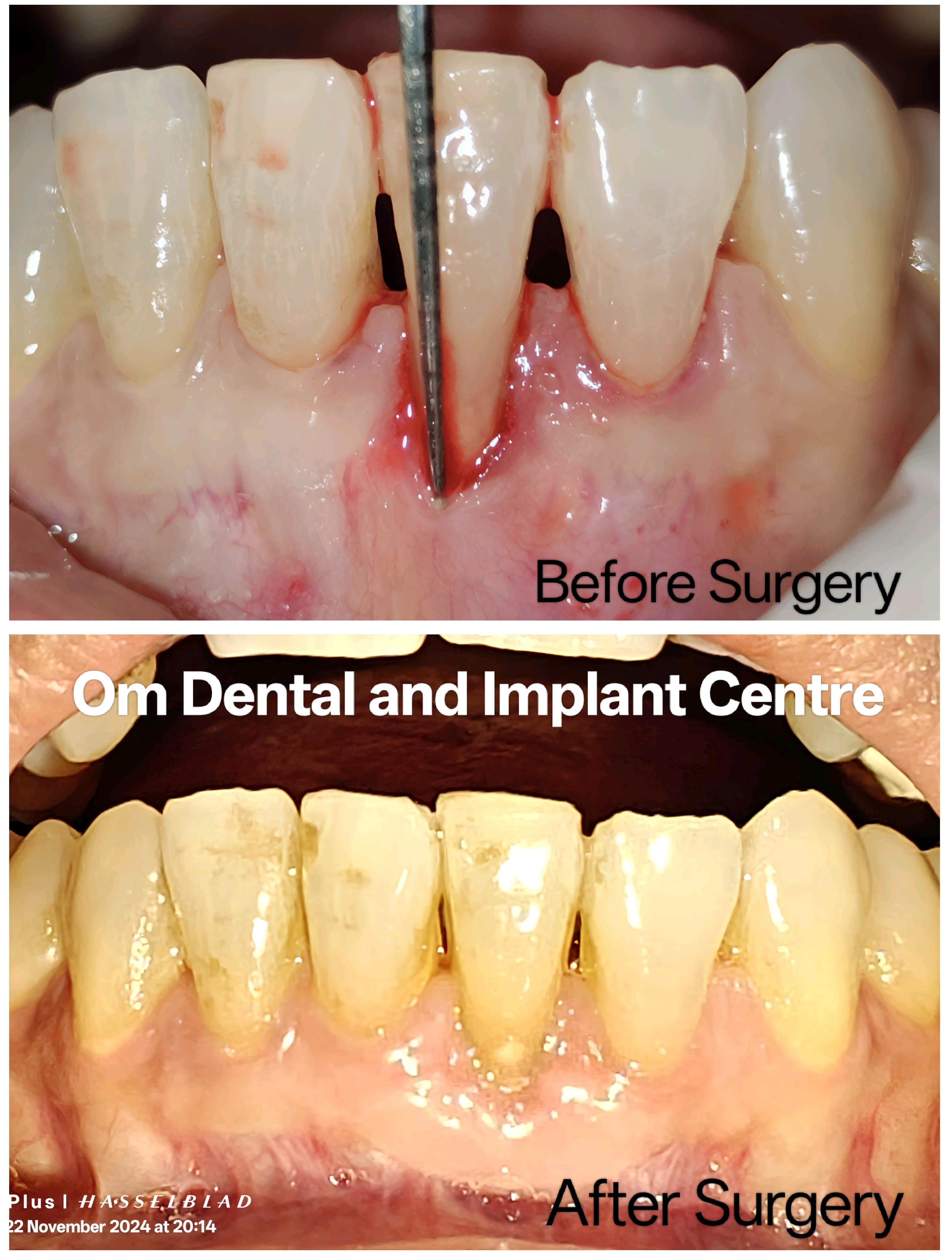 Gingival grafting
Periodontal plastic surgerie... main image