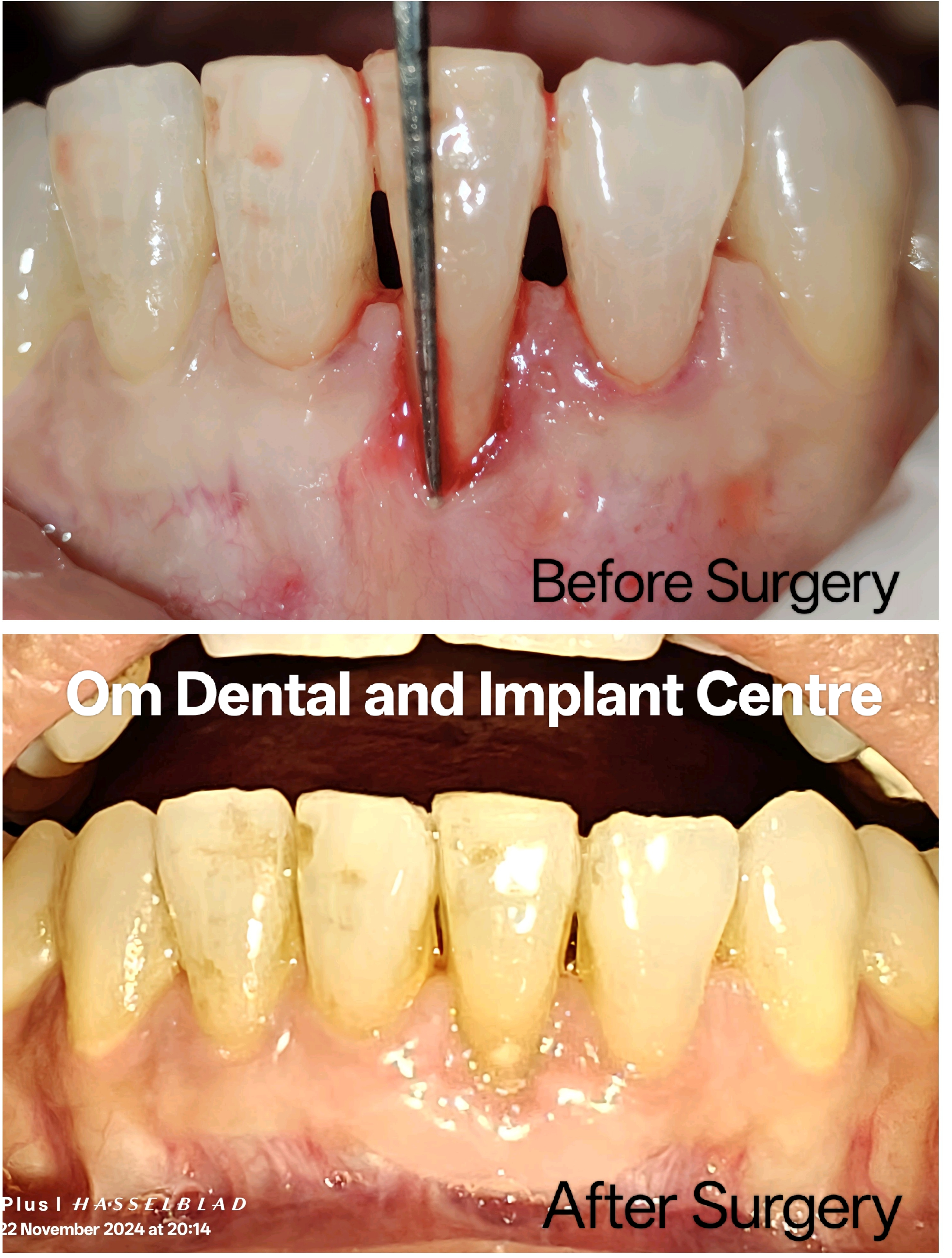 Gingival grafting
Periodontal plastic surgerie... main image