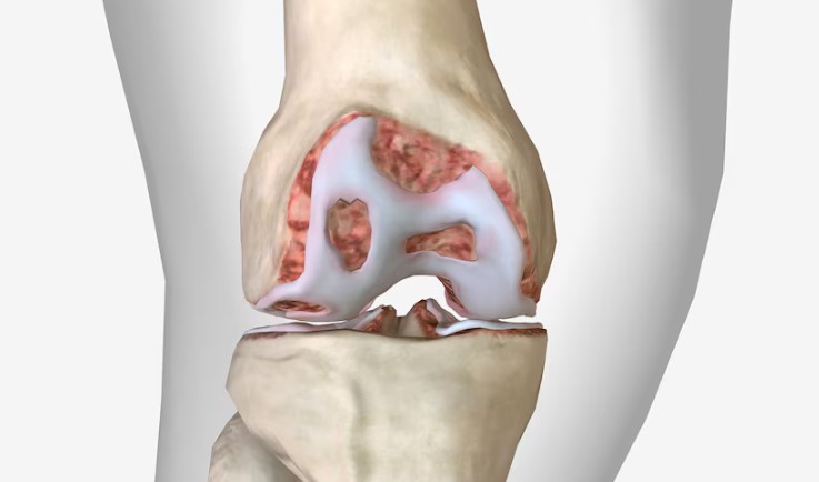 Knee Replacement Hospital in Pune: Advanced Surgic... main image