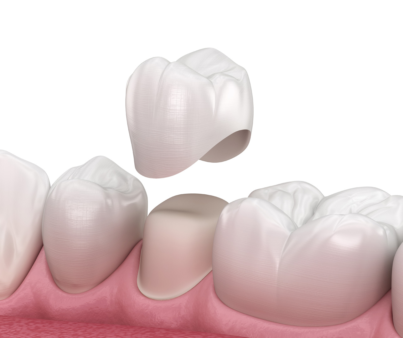 High quality 'Dental Crowns' available at Dr Bo... main image