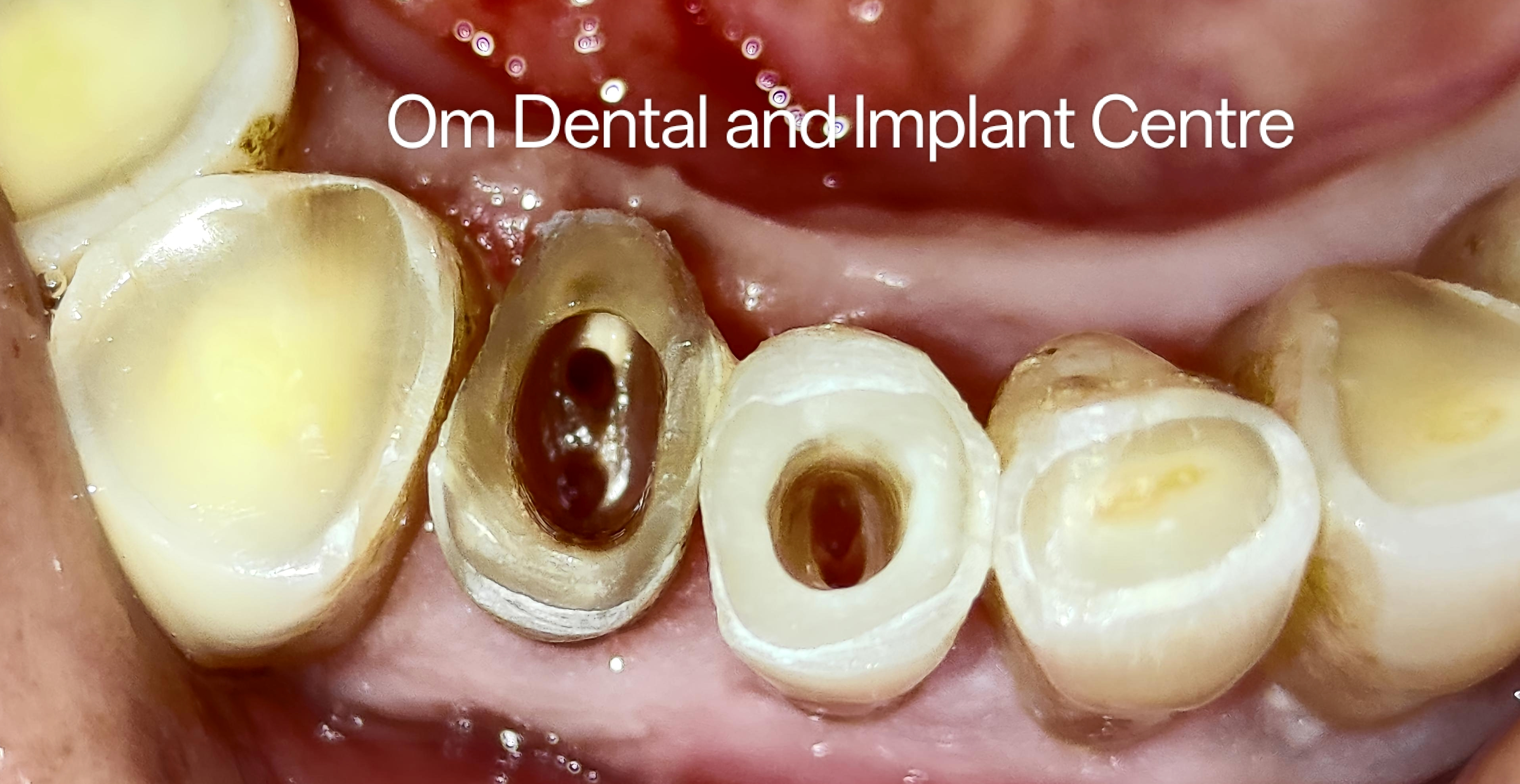 Root Canal Treatments 
These treatments are the... main image