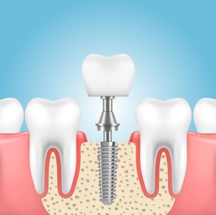 Best Implants Services in Nagpur For those looking... main image