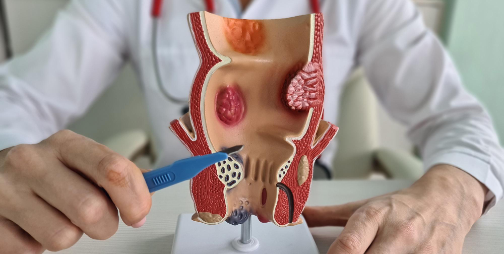 Fistula Clinic in Velachery: Comprehensive Trea... main image