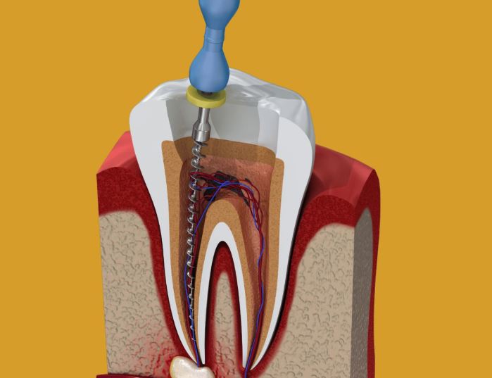 Best Root Canal Specialist in Nagpur If you’re str... main image