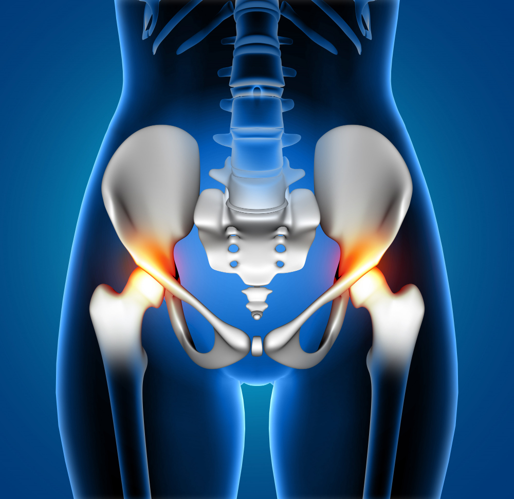 Best Hip Replacement Surgery in Chennai Hip rep... main image