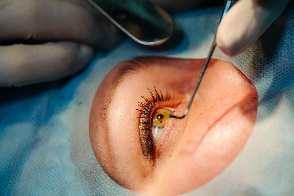 Pterygium Removal: Restore Comfort and Clarity ... main image