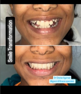 💎Smile transformation with invisible braces…💎
.... main image