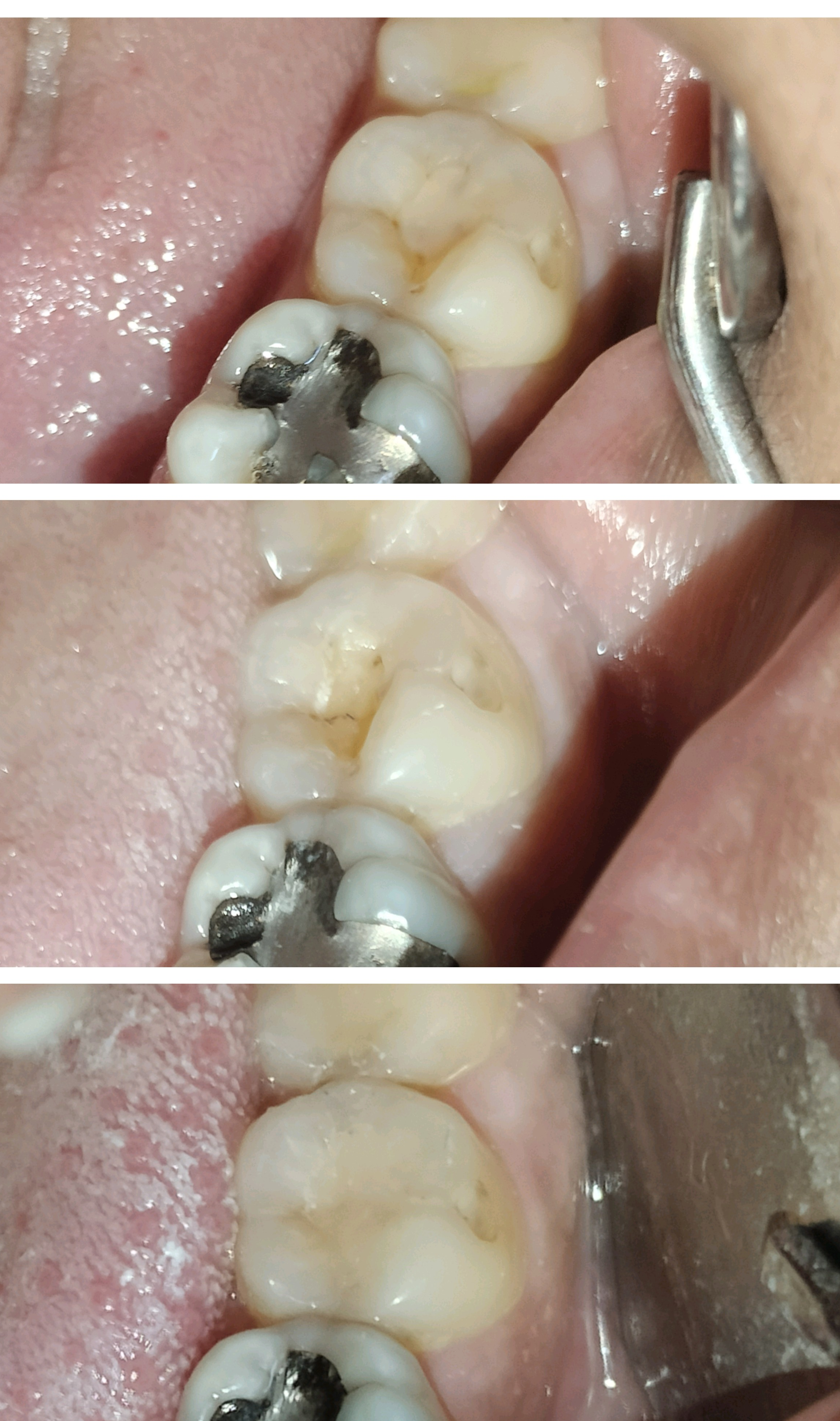 Replacement of old fillings done @ Dent-O-Facia... main image